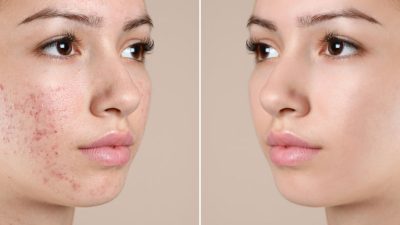 femme-acne-avant-apres