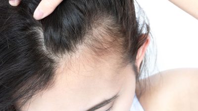 chute-cheveux-femme