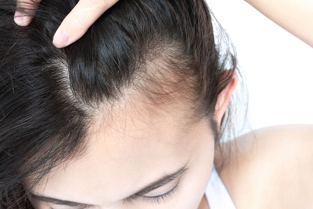 chute-cheveux-femme