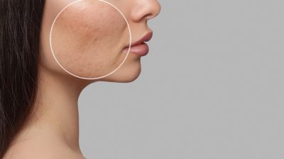 cicatrices-acnes