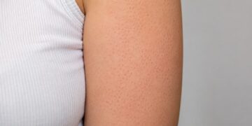 causes keratose pilaire peau
