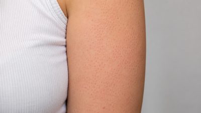 causes keratose pilaire peau