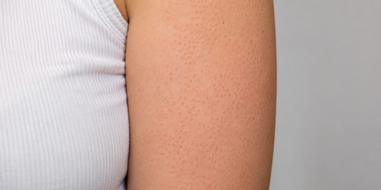 causes keratose pilaire peau
